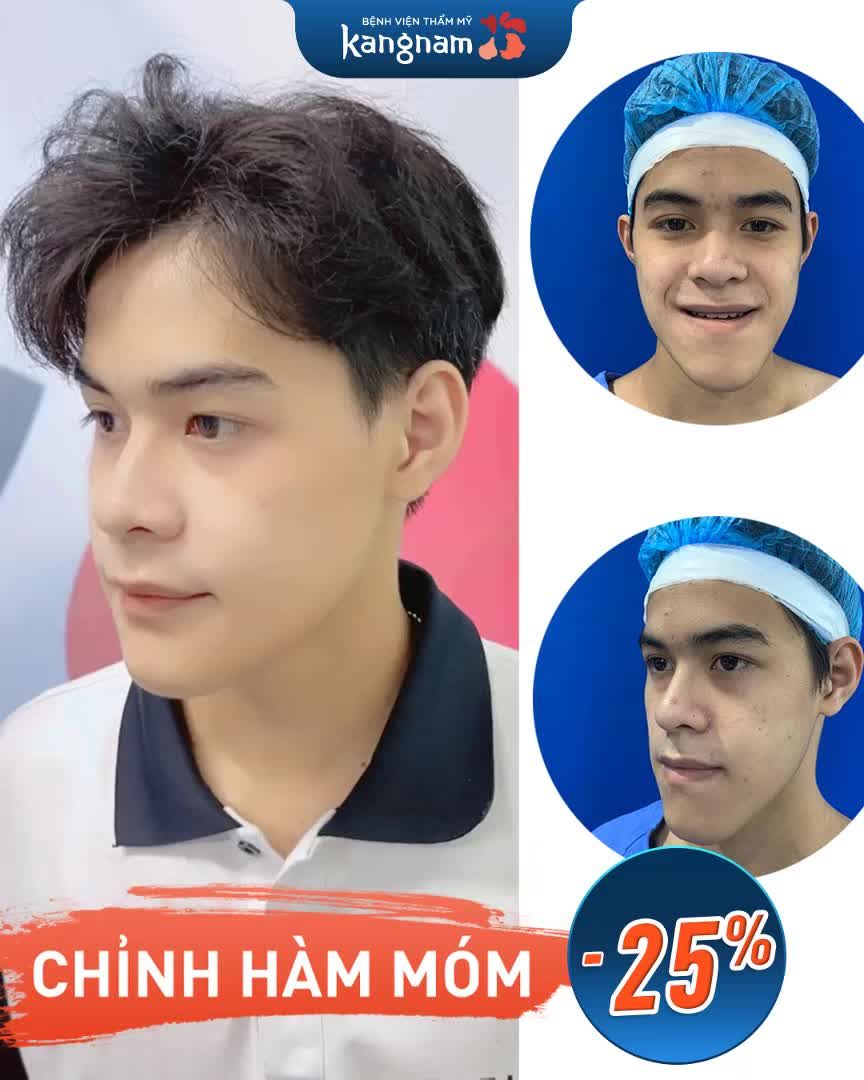 Pha giải cứu mặt móm quá ngoạn mục nhờ combo CHỈNH 2 HÀM + GỌT CẰM