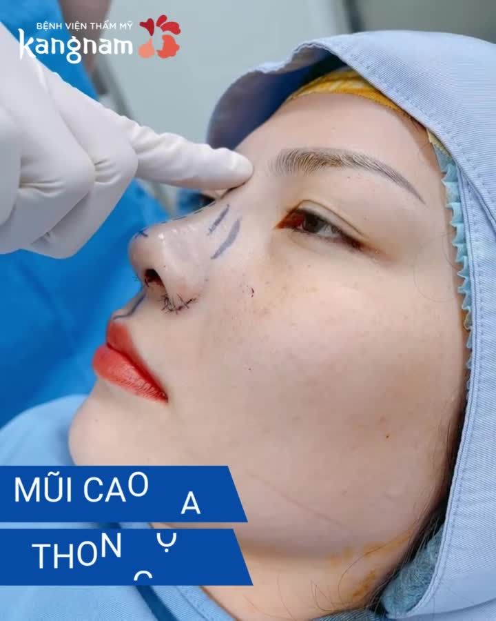 Sống mũi thấp, cánh mũi to  Chị khách mong muốn có dáng mũi cao, trông tự nhiên nhất