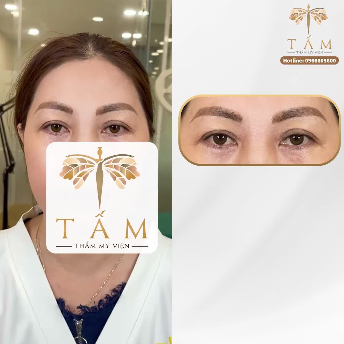 Biến đổi đôi mắt sau khi Nâng cung chân mày sẽ như thế nào