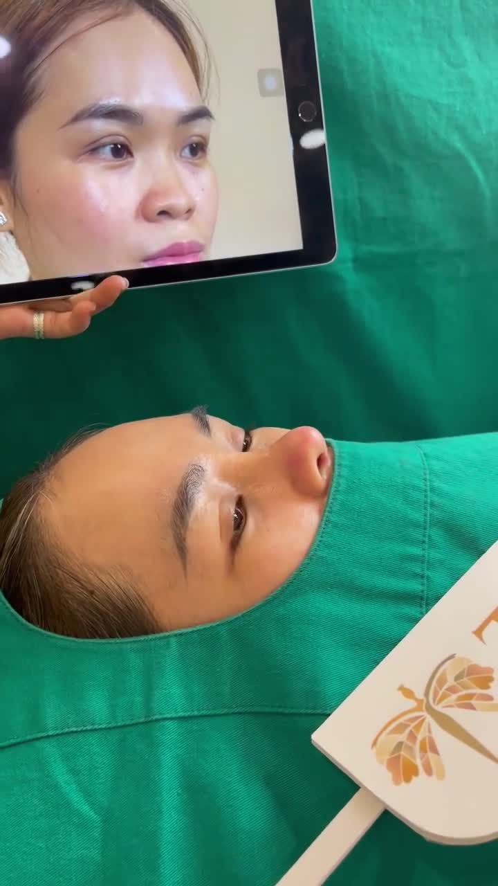 Mũi khách hàng sau cắt chỉ không hề sưng bầm