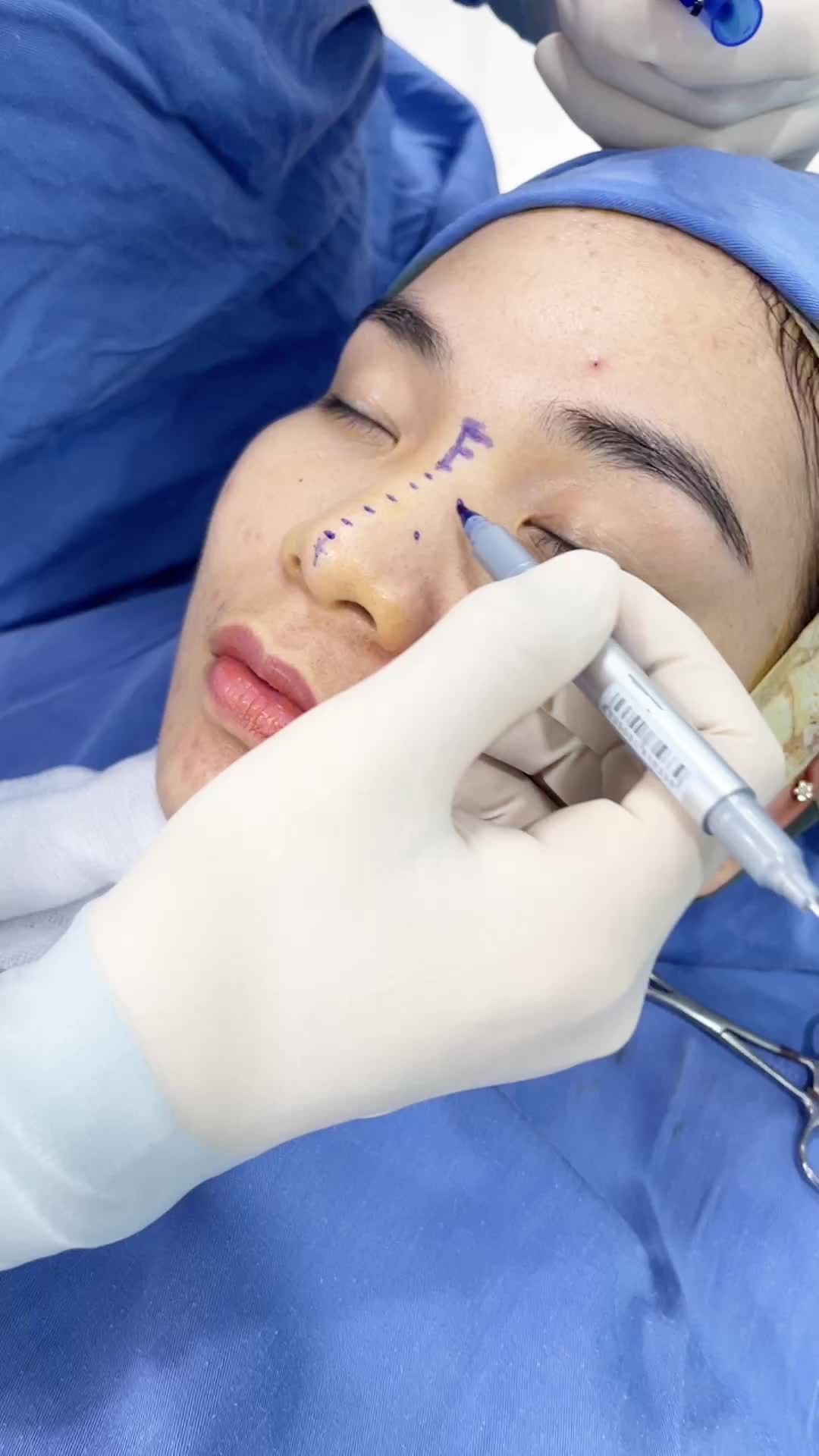Phân tích phẫu thuật Nâng mũi 6D Sugiform