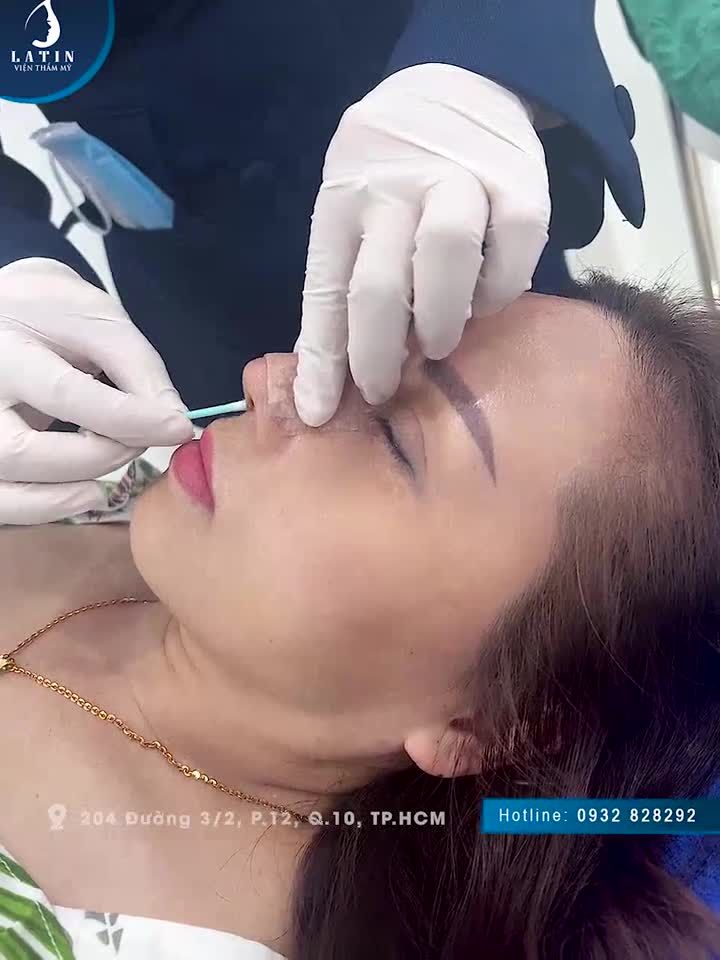 Cùng chiêm ngưỡng diện mạo chị khách hàng từ nước ngoài bay về nhà ????? sau nâng mũi tái cấu trúc thay đổi như thế nào nhé!
