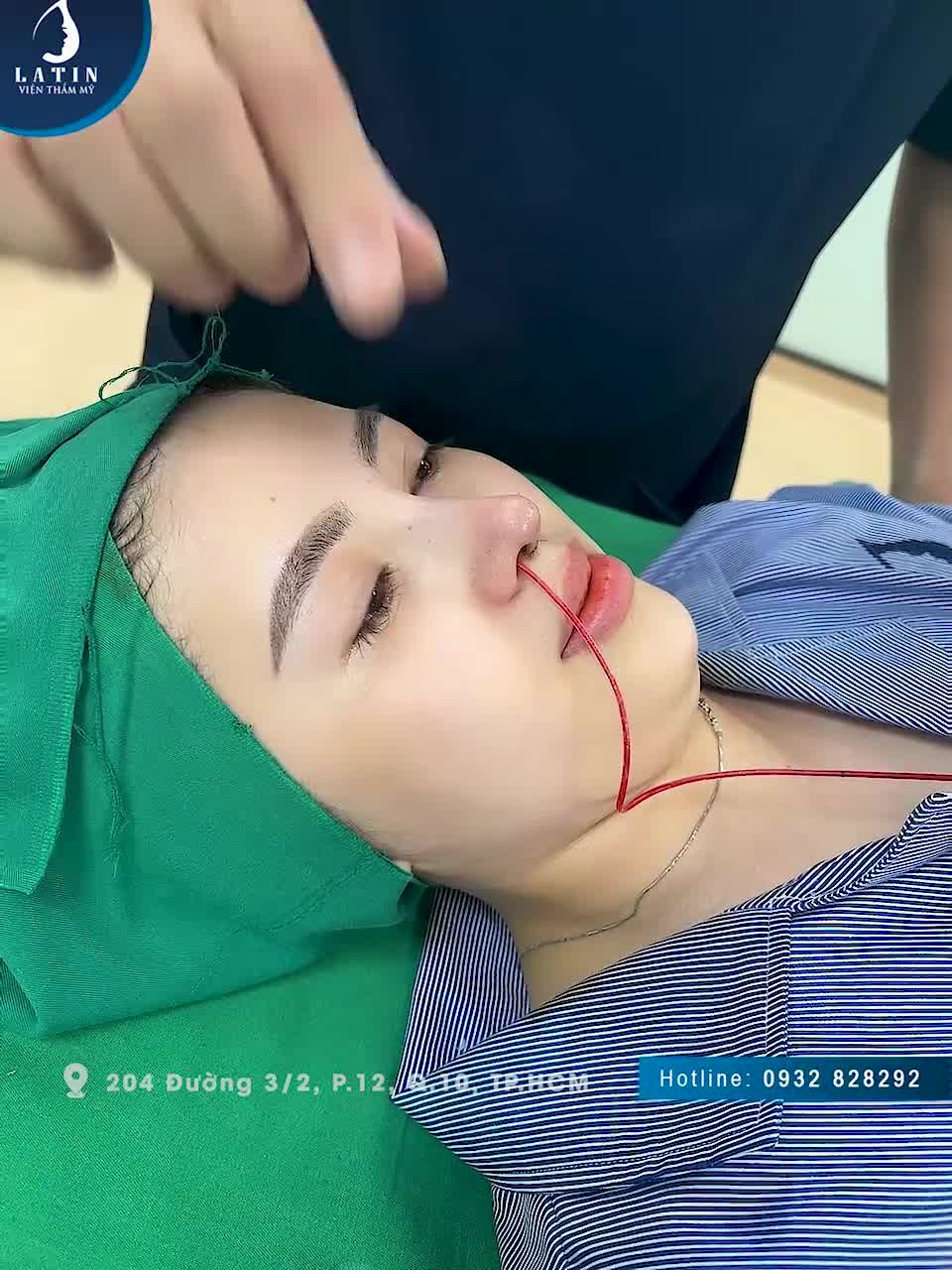 Kết quả ca nâng mũi cấu trúc muộn tại ????? ngày hôm qua