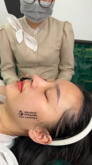 NÂNG MŨI CẤU TRÚC SỤN SINH HỌC MỸ SAU 10 NGÀY SẼ NHƯ THẾ NÀO
