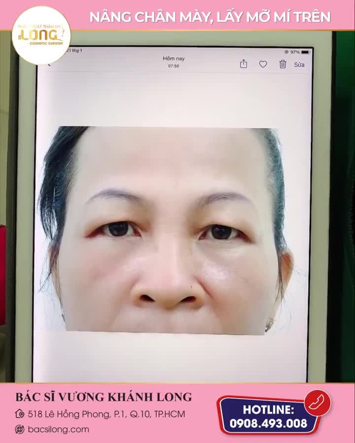 Có thể nói đây là phương pháp làm đẹp an toàn hạn chế xâm lấn nhất hiện nay, hiệu quả rõ rệt chỉ sau 1 lần thực hiện.