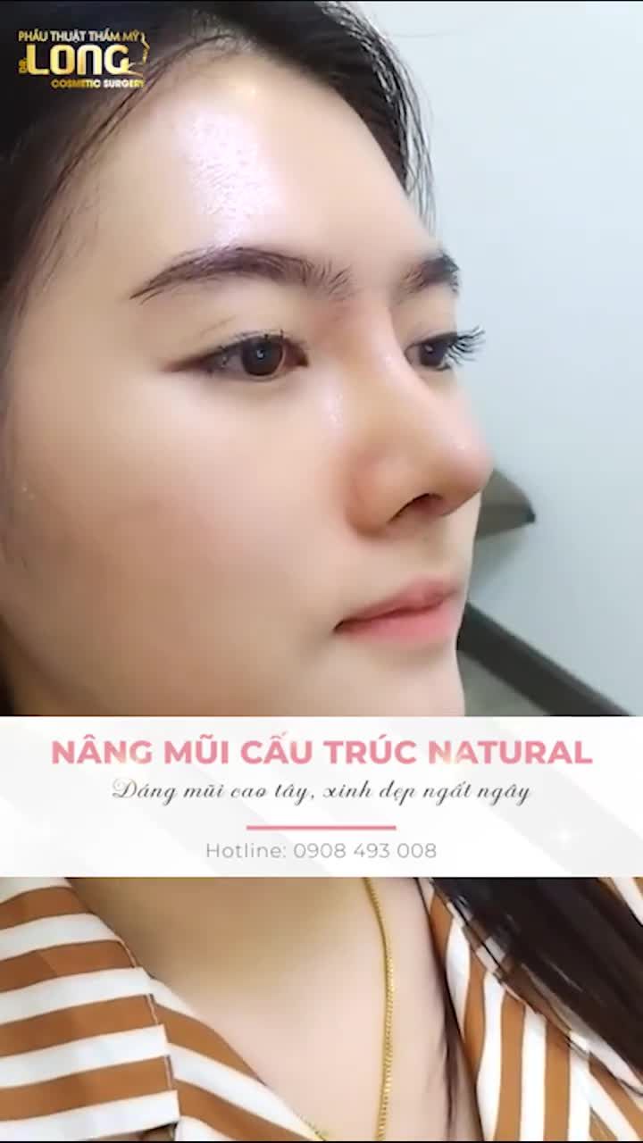 Tại nhờ NÂNG MŨI CẤU TRÚC NATURAL mới xinh như thế này đấy !