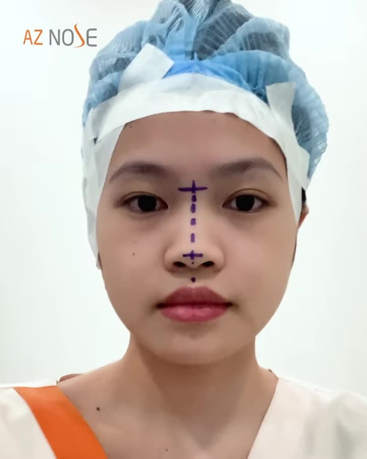 Gương mặt sẽ thay đổi thế nào với dáng mũi cao thon