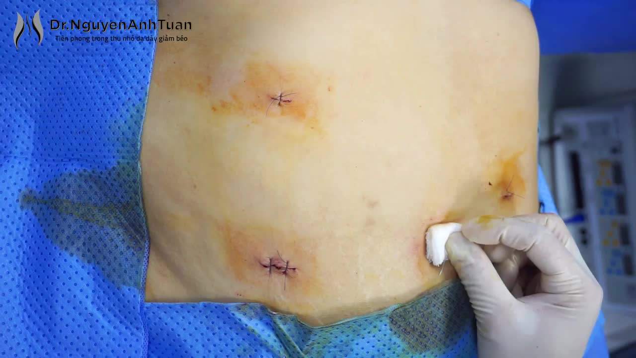Cận cảnh vết mổ trên bề mặt bụng của bệnh nhân ngay sau phẫu thuật ...