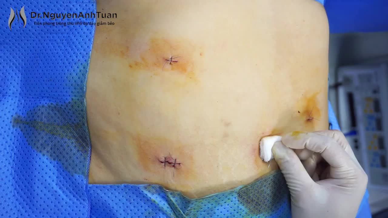 Cận cảnh vết mổ trên bề mặt bụng của bệnh nhân ngay sau phẫu thuật nội soi thu nhỏ dạ dày giảm béo.