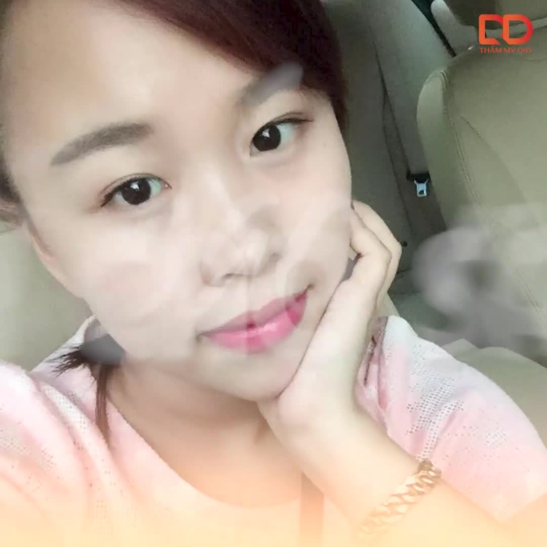 Combo Nâng mũi PERFECT DFORM và cắt mí ELITE EYES TIỂU PHẪU NHỎ NHƯNG KHÁC BIỆT LỚN