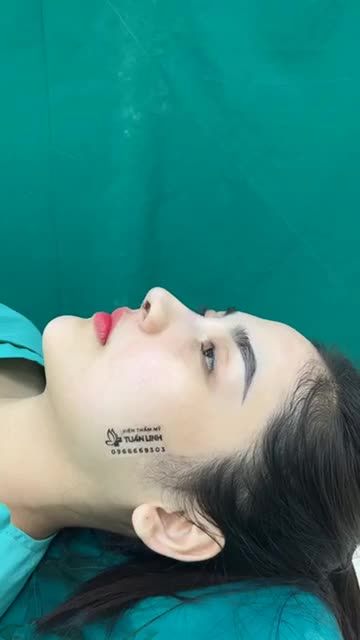 XINH ĐẸP TỎA SÁNG CÙNG DÁNG MŨI SIÊU CẤU TRÚC SURGIFORM CHỈ SAU 90 PHÚT PHẪU THUẬT