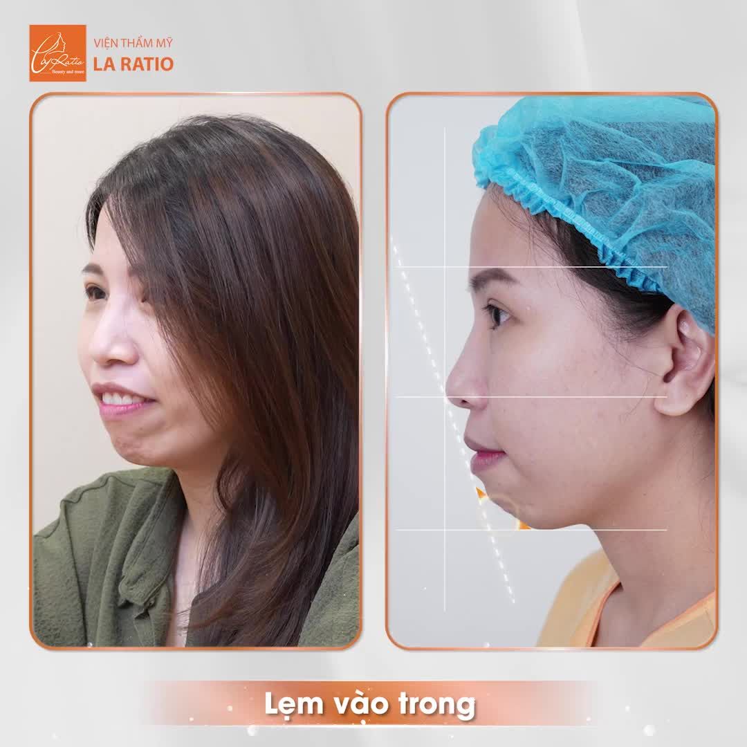 Cùng lắng nghe chia sẻ của khách hàng Li Li sau khi thực hiện Phẫu thuật THẨM MỸ CẰM 6D tại Viện Thẩm Mỹ La Ratio nhé!