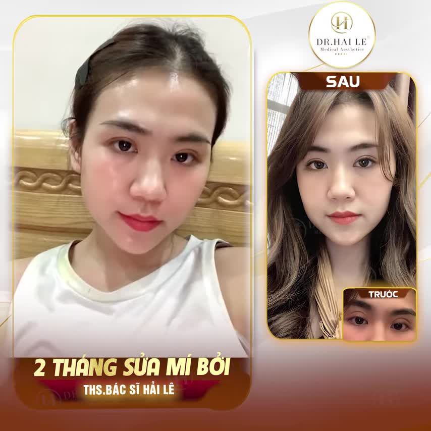 Hello mọi người, sau đây là câu chuyện “Suýt bócphốt OAN bác sĩ Hải Lê của em