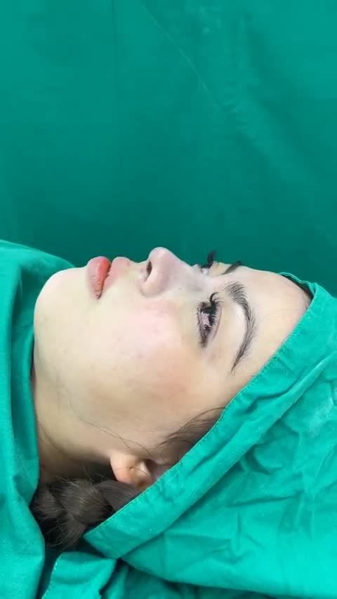 Sợ phẫu thuật nên chọn tiêm filler mũi nhưng dáng mũi không cải thiện được gì...nên chị quyết tâm phẫu thuật sửa lại mũi tại Tuấn Linh