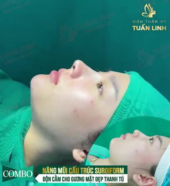 NÂNG MŨI CẤU TRÚC SURGIFORM + ĐỘN CẰM VLINE PLASMA