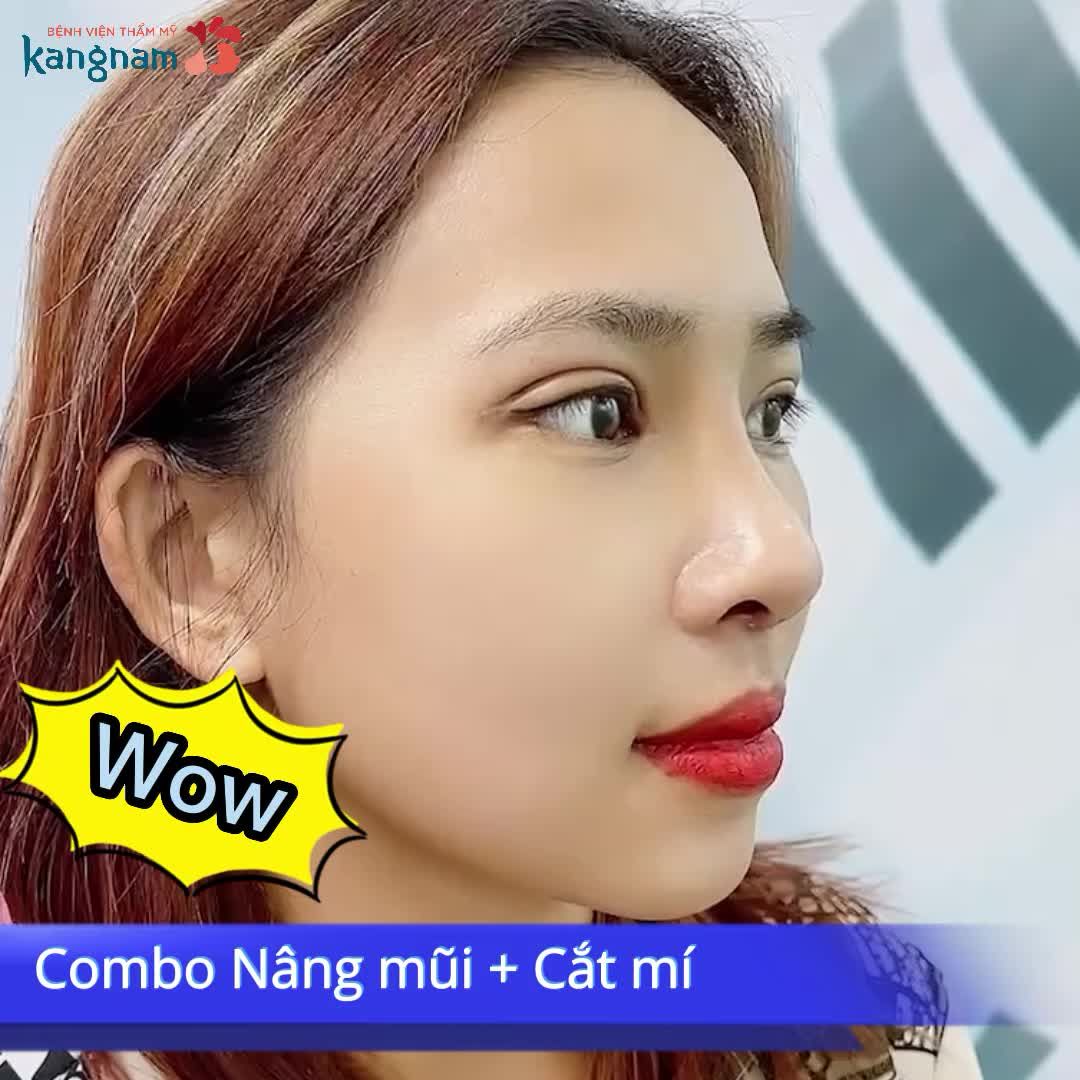 Combo Mũi Mí Tiểu phẫu nhẹ nhàng - Đẹp đỉnh cao!!