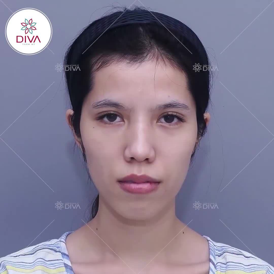 GƯƠNG MẶT MỀM MẠI, TRẺ TRUNG RẠNG NGỜI SAU CẤY MỠ COLEMAN