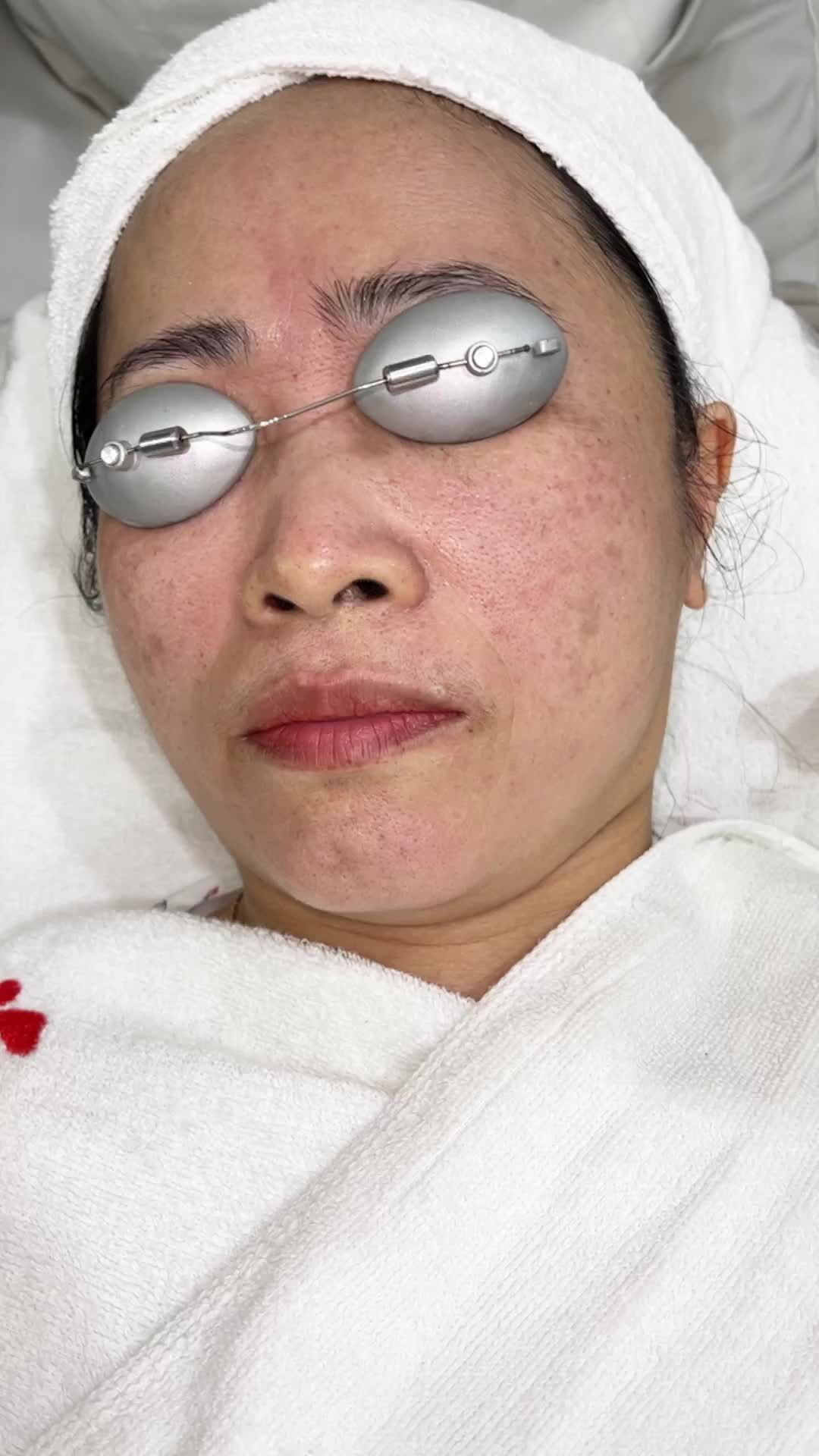 Điều trị Combo Nám + Tàn nhang với Laser Picosure buổi đầu tiên.
