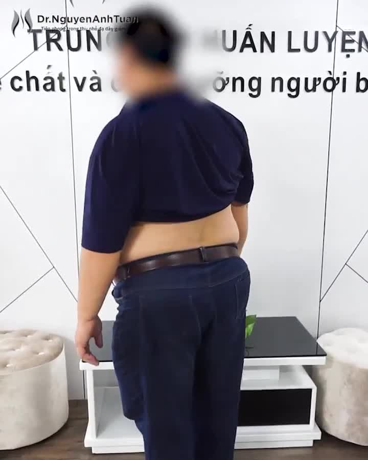 Phẫu thuật thu nhỏ dạ dày thành công cho bệnh nhân nam 50 tuổi, nặng 115kg, BMI 41.