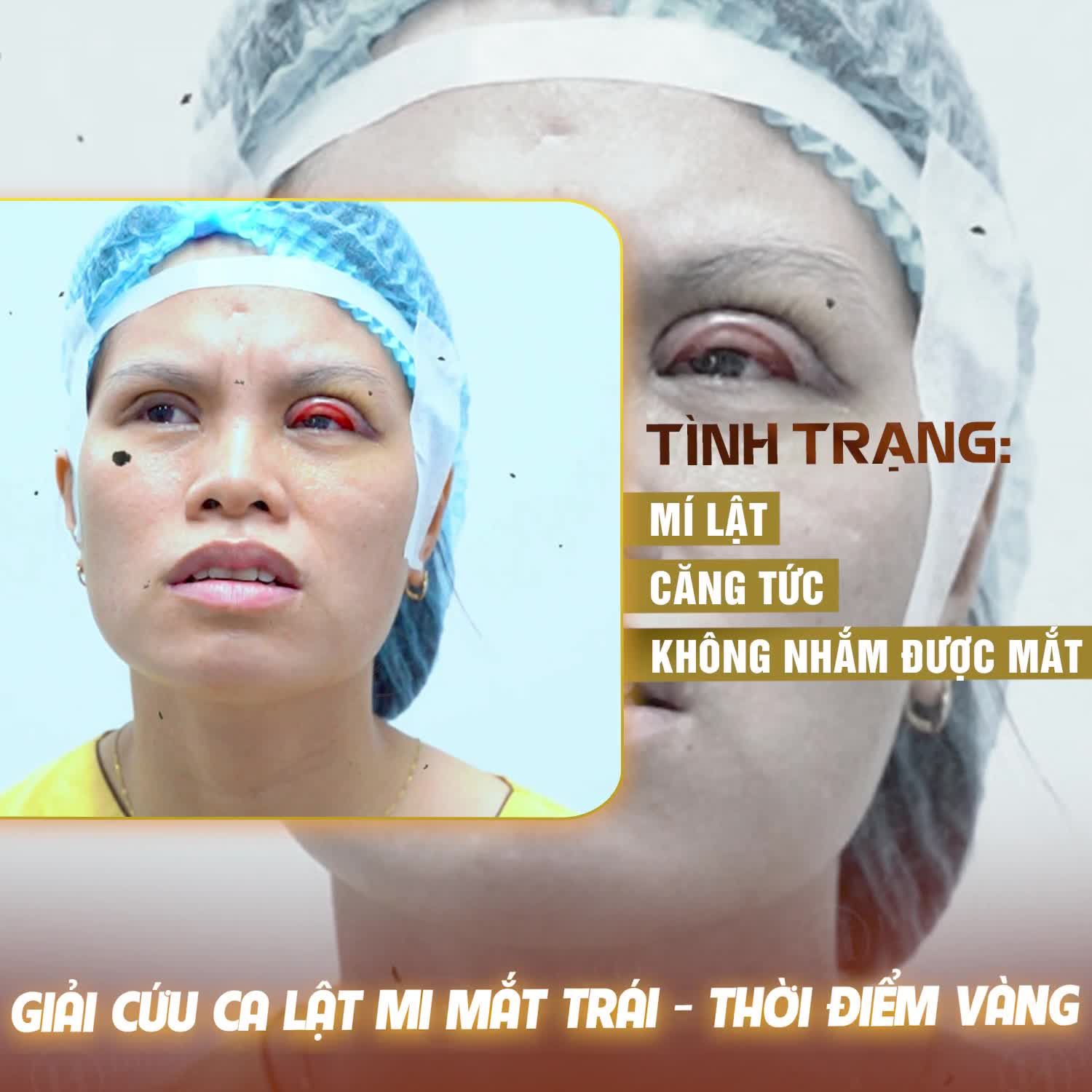 Ths.Bác sĩ Hải Lê tiếp nhận và cấp cứu kịp thời ca lật mi mắt trái cấp độ nặng trong thời điểm từ 0 - 12 ngày.