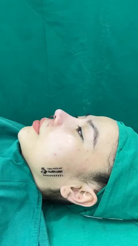 Đã từng nâng mũi 3 lần nhưng chị hoàn toàn thất vọng  .Lần thứ 4 chọn Nâng mũi tái cấu trúc phức tạp sử dụng sụn Surgiform tại Tuấn Linh = Sẽ cho kết quả như thế nào