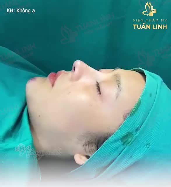 Khách hàng chọn Nâng mũi siêu cấu trúc sụn Surgiform Sụn nâng cao cấp nhập khẩu chính hãng với độ tương thích lên tới 97% giúp dáng mũi bền đẹp mãi mãi.
