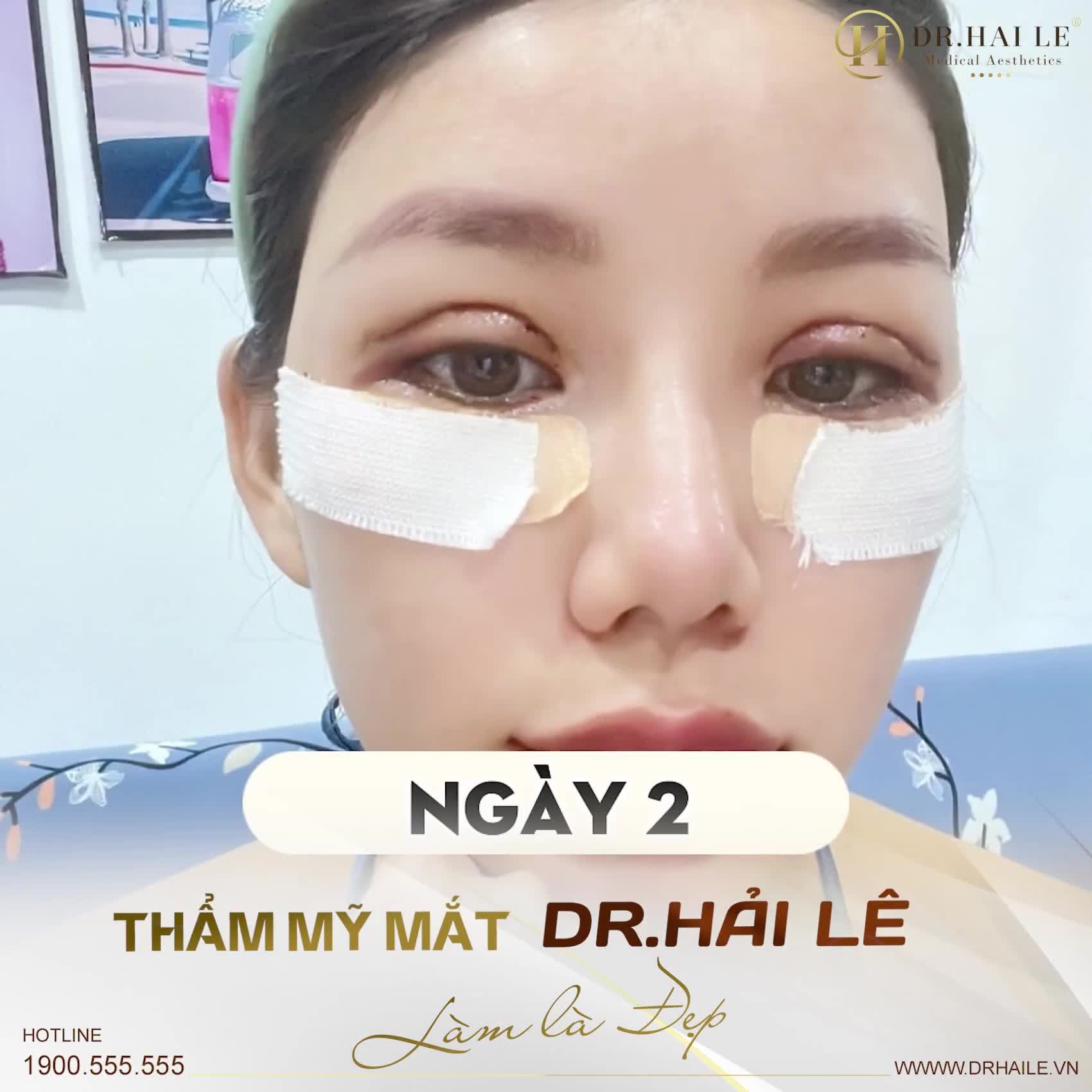 Bạn có đang tò mò, cắt mí sau 1 ngày, 2 ngày, 3 ngày, 5 ngày, 7 ngày....trông sẽ như thế nào