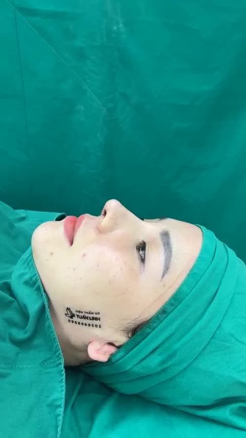 Phương pháp thực hiện Nâng mũi cấu trúc