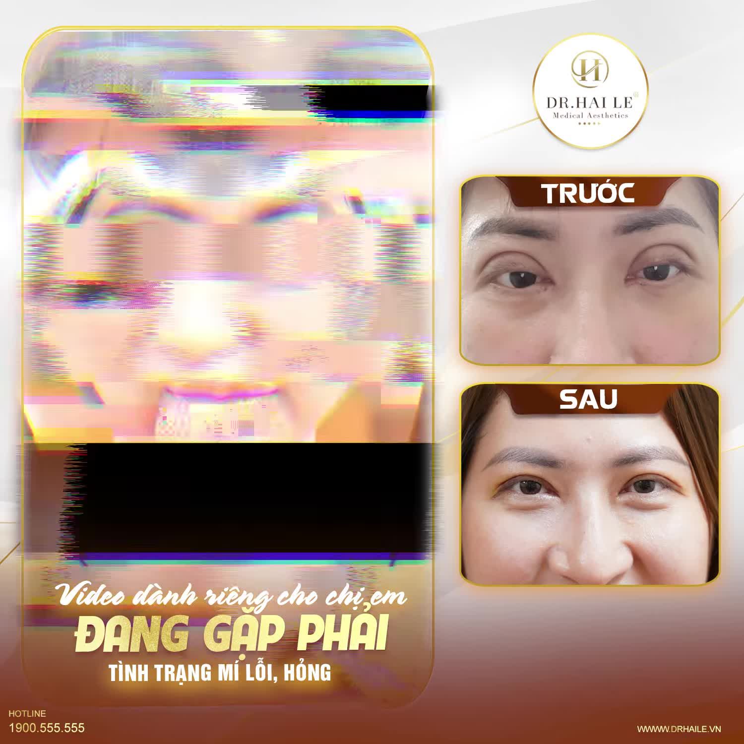 Bạn đang gặp phải tình trạng mí lỗi, hỏng thì video này đích thị dành riêng cho bạn!