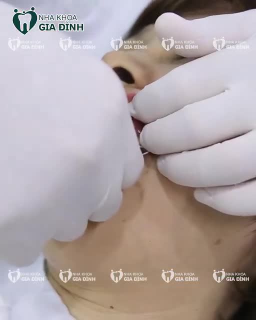 BỀN ĐẸP TRỌN ĐỜI CÙNG THẨM MỸ RĂNG SỨ TẠI NHA KHOA GIA ĐÌNH