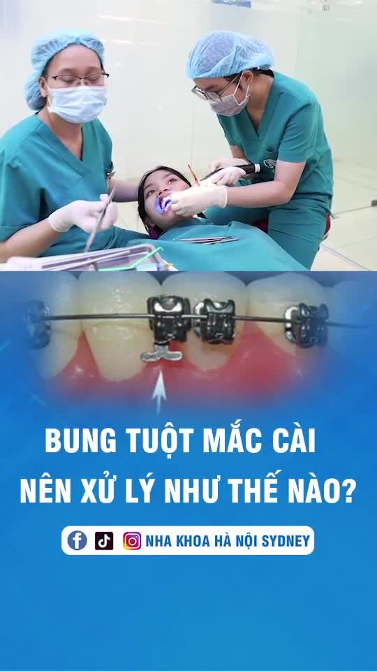 Bung tuột mắc cài nên xử lý như thế nào