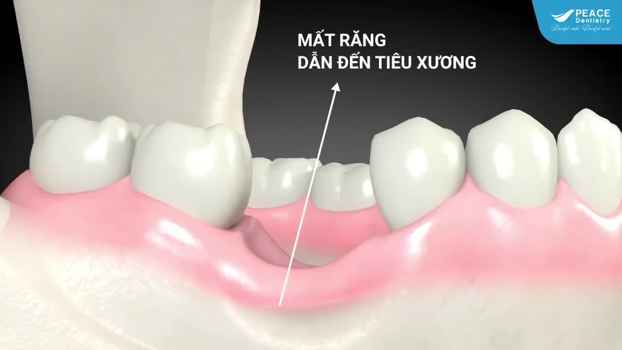 CÁC TRƯỜNG HỢP CẦN GHÉP XƯƠNG KHI CẤY GHÉP IMPLANT