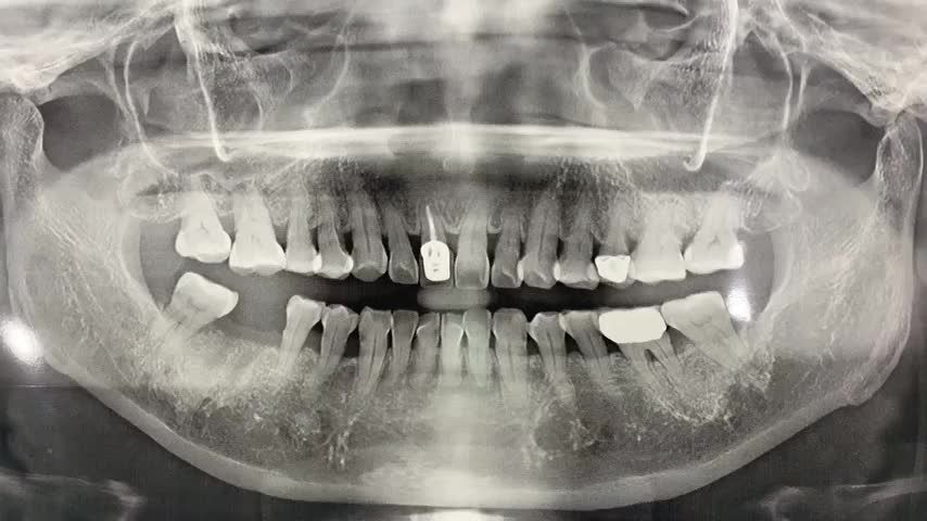 Cấy ghép implant khôi phục răng 46 bị mất cho khách hàng tại Nha Khoa Thùy Anh cơ sở TP. Phổ Yên.