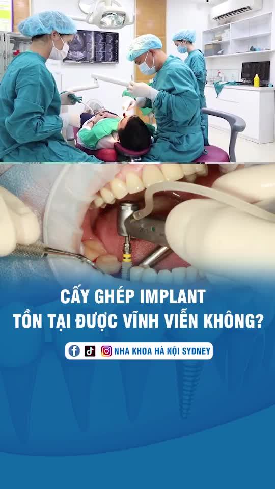 Cấy ghép răng implant tồn tại được vĩnh viễn không