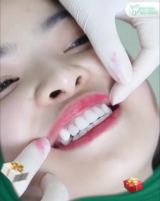 CHỈ CÒN 20 SUẤT TRONG THÁNG NÀY!!! THẨM MỸ RĂNG