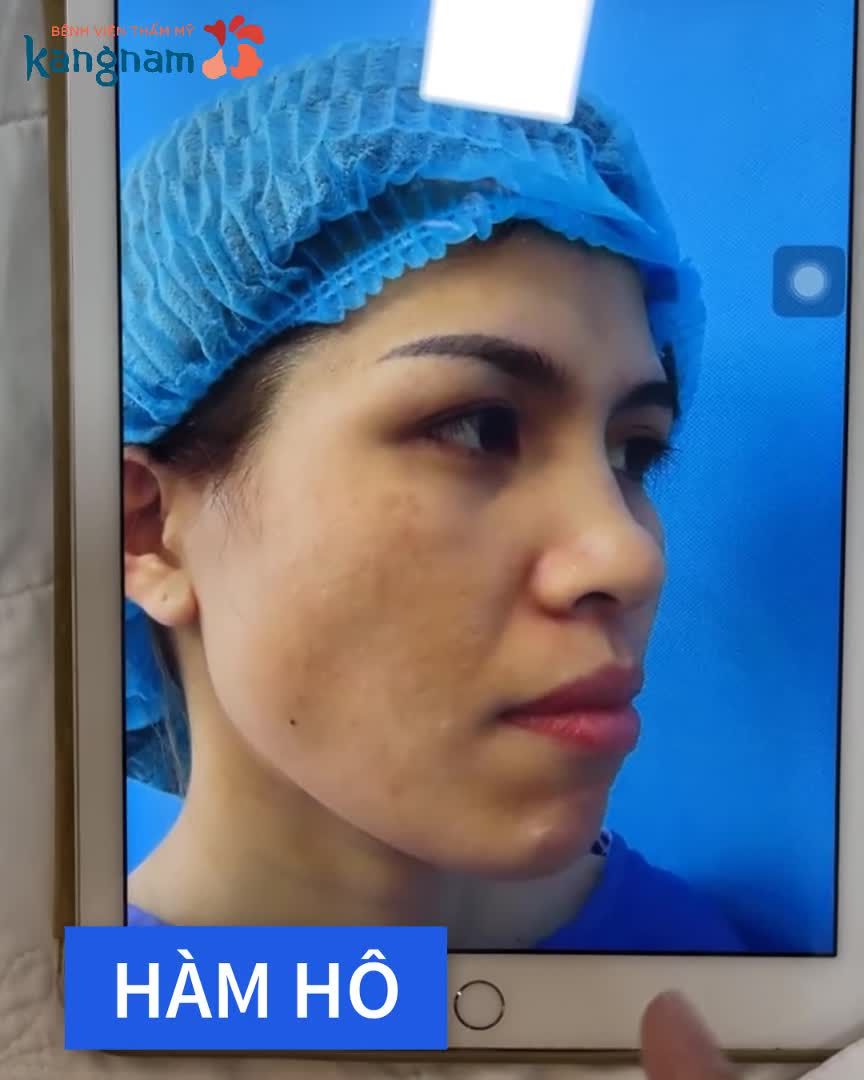 Chị thấy khỏe hơn rồi, chỉ thấy hơi tê chút thôi - Chị khách hàng chia sẻ sau chỉnh hàm hô