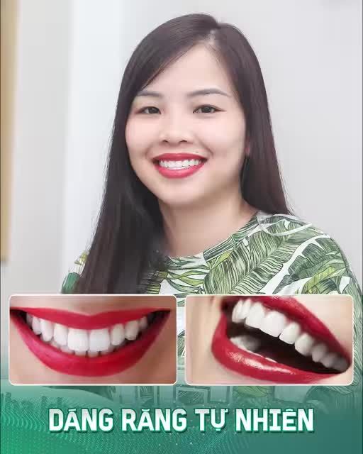 CHỌN DÁNG RĂNG - ĐẸP NHƯ Ý CHỈ SAU 2 NGÀY