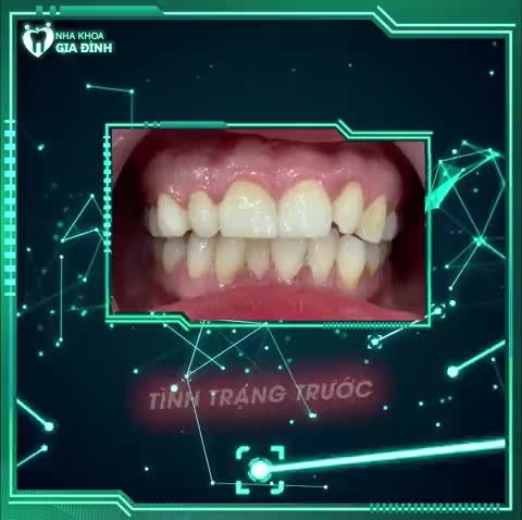 ĐẸP SANG TRỌN ĐỜI CÙNG RĂNG SỨ THẨM MỸ TẠI NHA KHOA GIA ĐÌNH