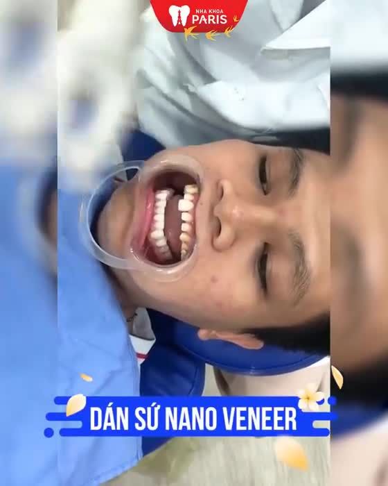 Hết Ố Vàng Mòn Men 60 phút thực hiện