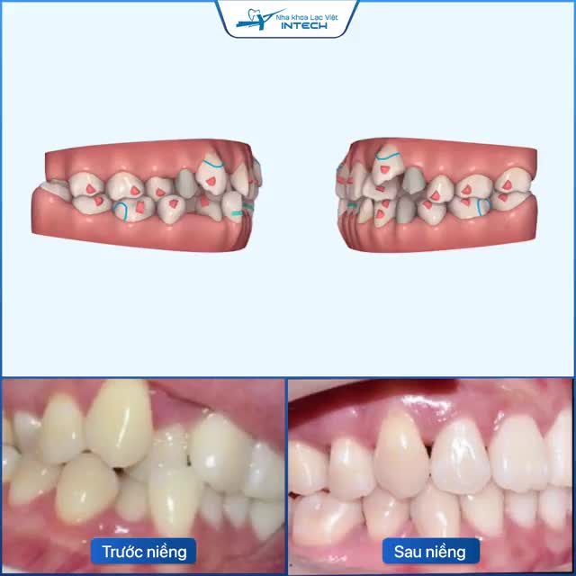INVISALIGN KHẮC PHỤC HOÀN TOÀN RĂNG CHEN CHÚC, KHẤP KHỂNH
