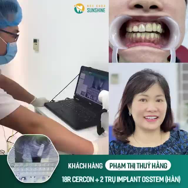 Khách hàng PHẠM THỊ THUÝ HẰNG thực hiện bọc 18 răng sứ