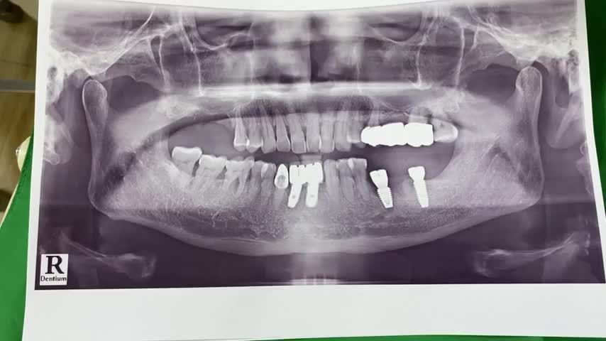 Lắp răng implant số 6 7 cho chú khách hàng tại Nha Khoa Thuỳ Anh tp. Thái Nguyên.