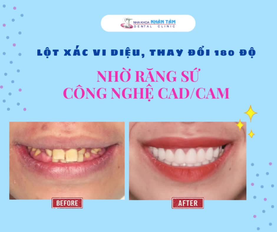 LỘT XÁC VI DIỆU, THAY ĐỔI 180 ĐỘ NHỜ RĂNG SỨ CÔNG NGHỆ CADCAM