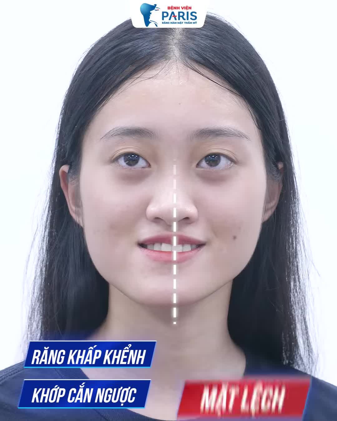 Mặt lệch, khớp cắn ngược mất tự tin