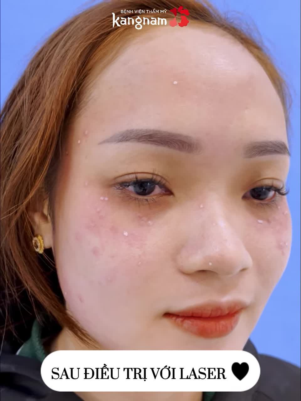 Nàng khách Trị tàn nhang tươi hết cỡ sau điều trị