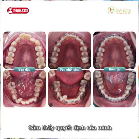 NIỀNG RĂNG CHEN CHÚC, KÉO RĂNG 8 THAY THẾ RĂNG 7 MẤT, HỎNG