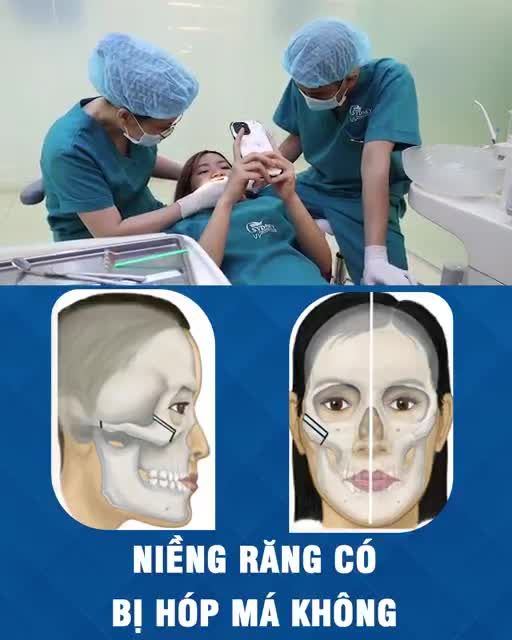 Niềng răng có bị hóp má không