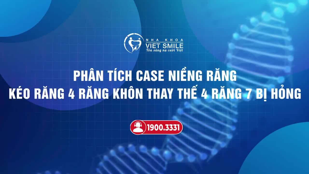 NIỀNG RĂNG - KÉO 4 RĂNG 8 THAY THẾ 4 RĂNG SỐ 7 BỊ SÂU VỠ, HỎNG
