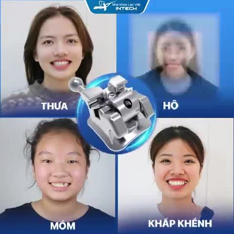 Niềng răng mắc cài kim loại tự động kết hợp với công nghệ X-Matrix