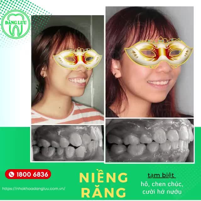 Nụ cười tự tin, hàm răng chuẩn khớp cắn sau hành trình niềng răng tại Hệ thống Nha Khoa Đăng Lưu!